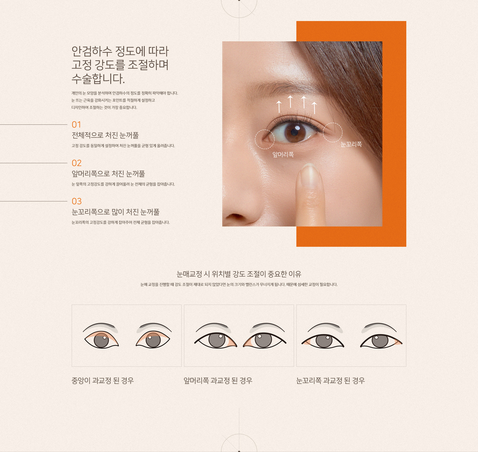눈매교정