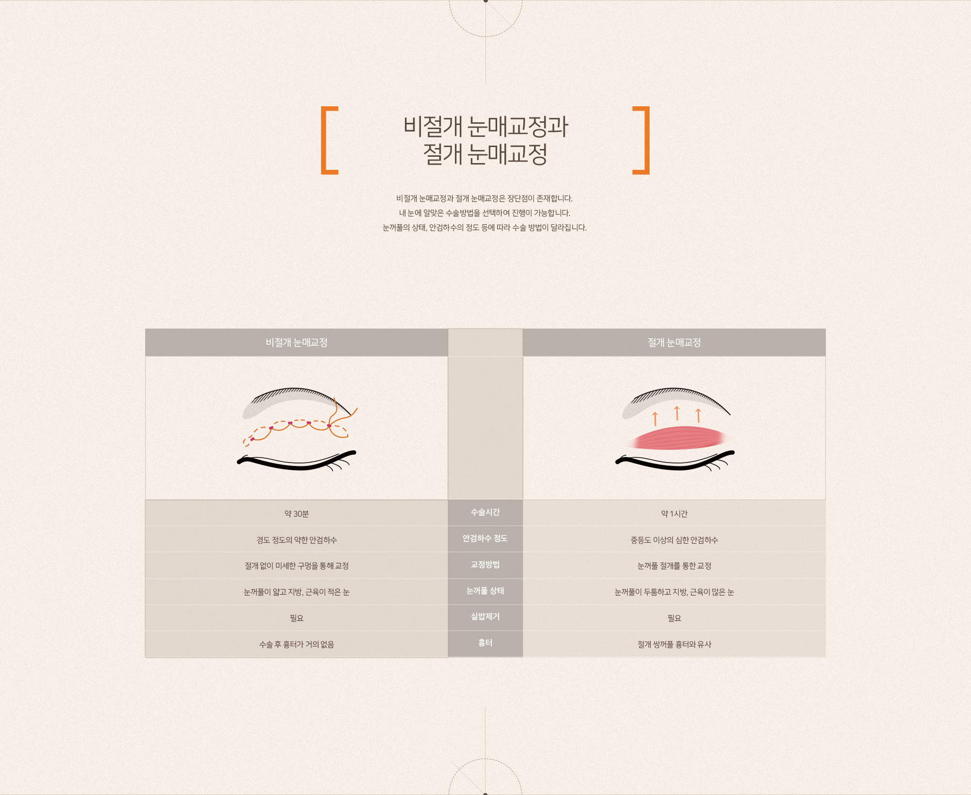 눈매교정