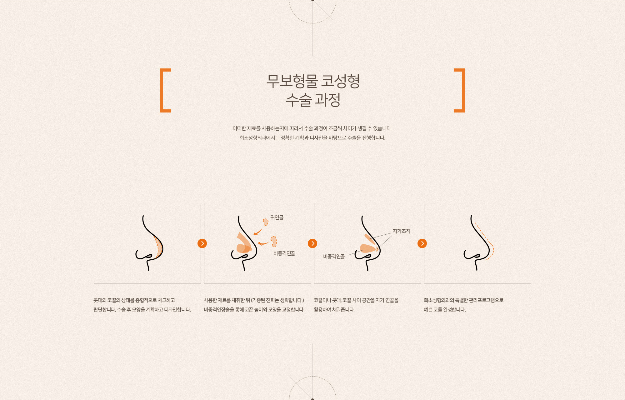 무보형물 코성형
