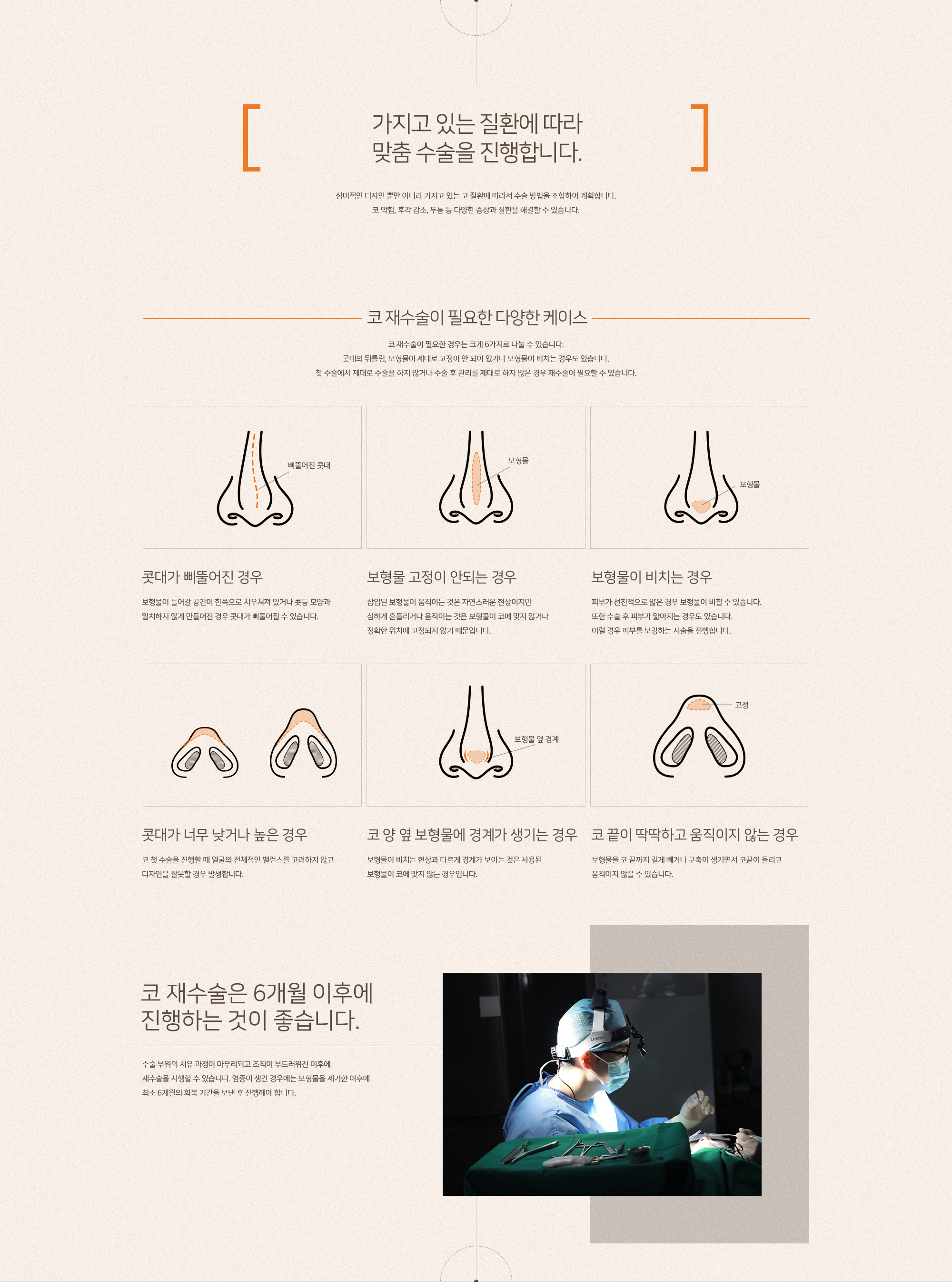 코 재수술