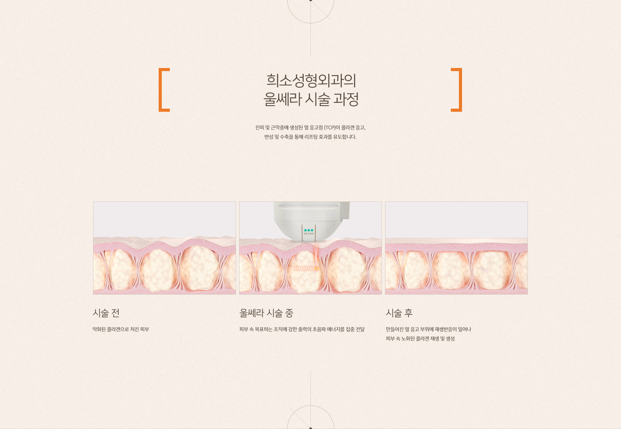 수면 울쎄라